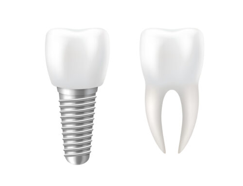 Dental Implants: The Best Solution to Missing Teeth