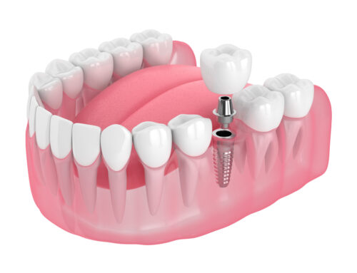 Taking Care of Dental Implants After Surgery: What To Expect