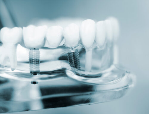 Benefits of Dental Implants Over Traditional Dentures